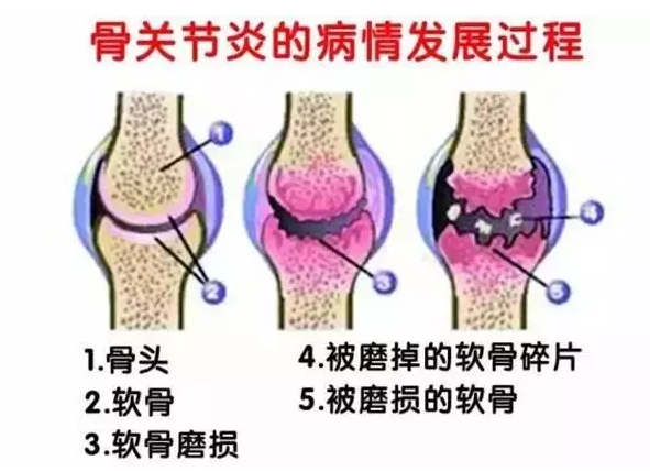 中老年人腿疼吃氨基葡萄糖真的有用吗？