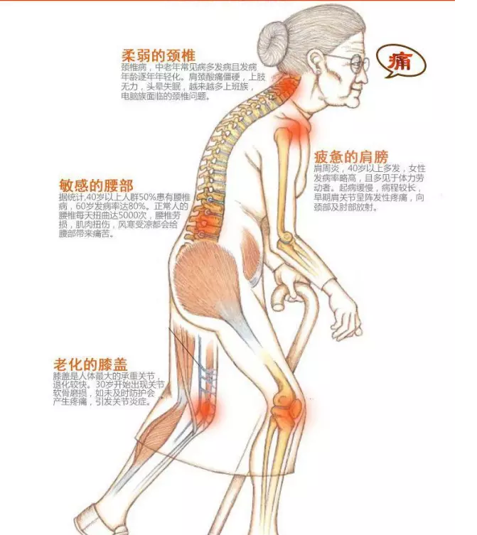 得了骨关节炎吃氨糖有用吗？骨关节修复需要氨糖！
