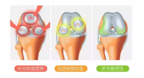 氨糖软骨素配方什么样的好？应该如何去选氨糖软骨素