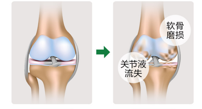 维力维氨糖软骨素中骨胶原有什么作用？