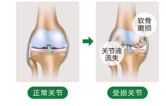 维力维详解：第三代氨糖软骨素中为何要加入骨胶原？