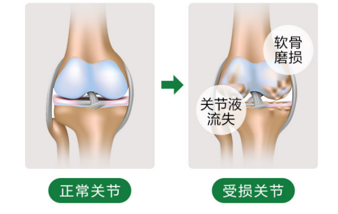 氨糖的功效与作用都有哪些？