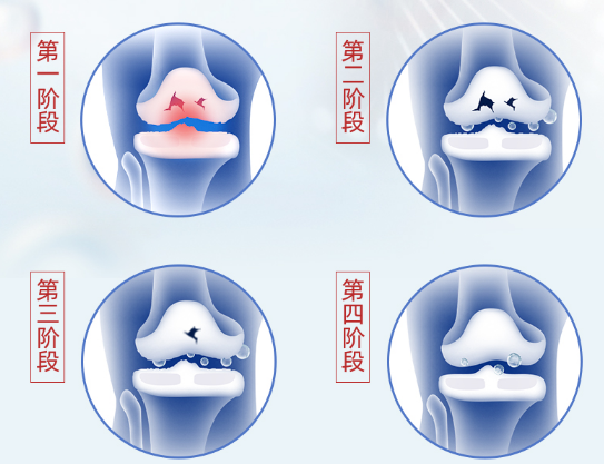 氨糖的作用和功效有哪些？以及氨糖有没有副作用？
